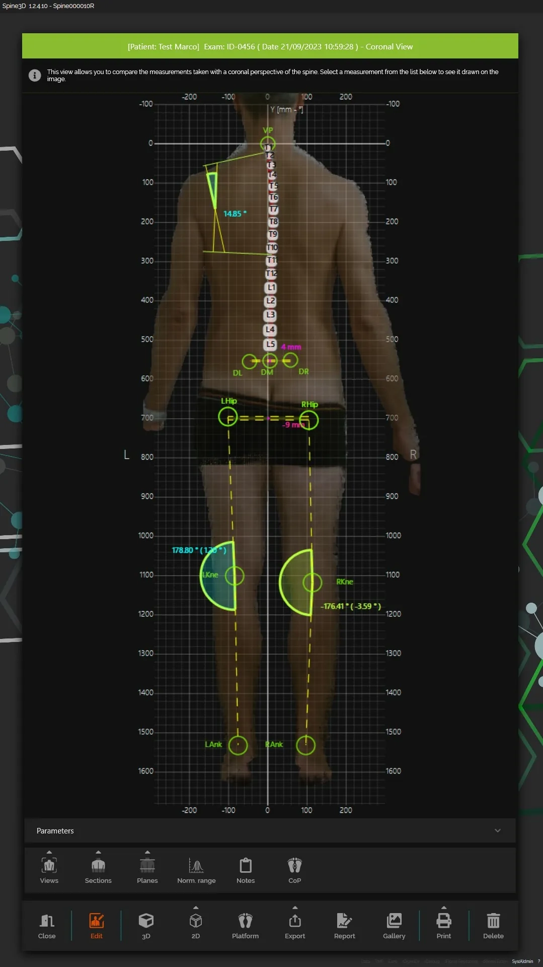 analiza kręgosłupa SPINE3D